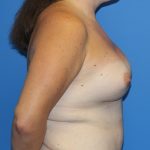 Breast Augmentation Before & After Patient #2763