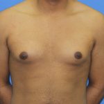 Gynecomastia Before & After Patient #2893