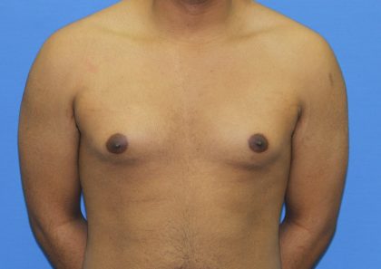 Gynecomastia Before & After Patient #2893