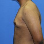 Gynecomastia Before & After Patient #2893