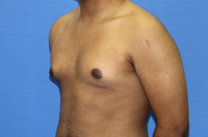 Gynecomastia Before & After Patient #2893