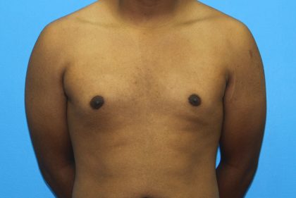 Gynecomastia Before & After Patient #2893
