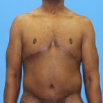 Gynecomastia Before & After Patient #2900