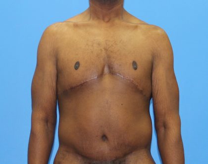 Gynecomastia Before & After Patient #2900