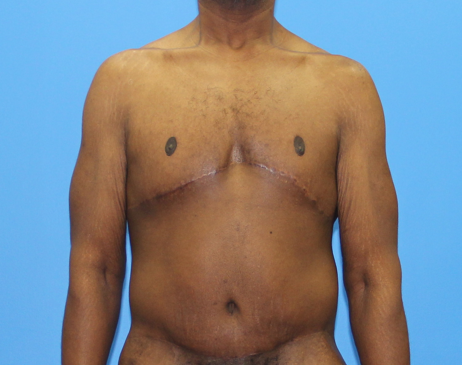 Gynecomastia Before & After Patient #2900