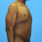 Gynecomastia Before & After Patient #2900