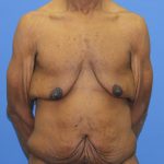 Gynecomastia Before & After Patient #2900