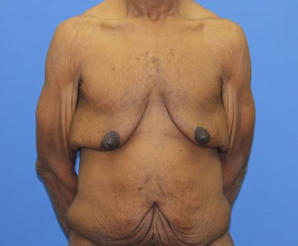 Gynecomastia Before & After Patient #2900