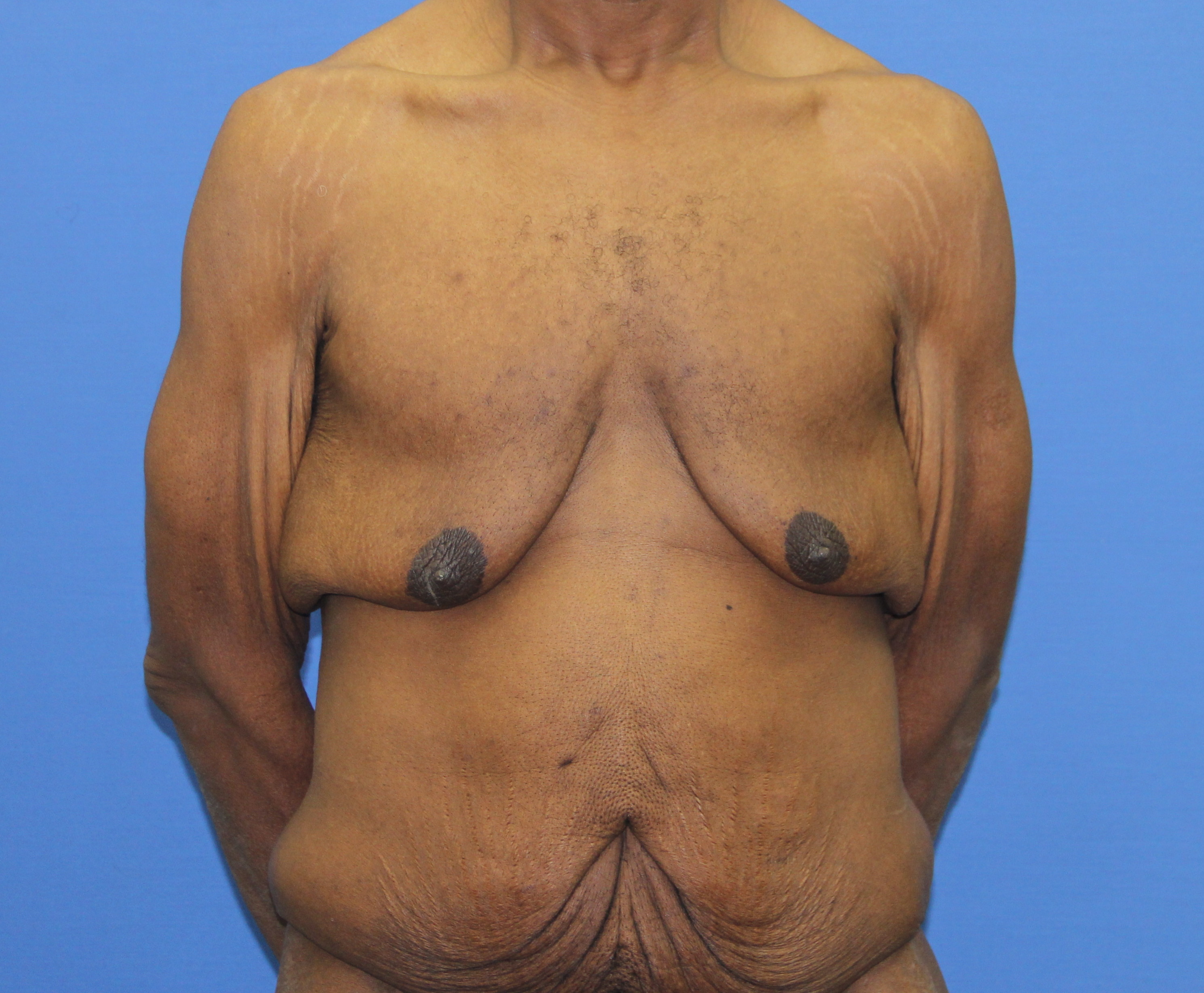 Gynecomastia Before & After Patient #2900