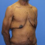 Gynecomastia Before & After Patient #2900