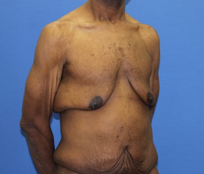 Gynecomastia Before & After Patient #2900