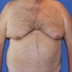 Gynecomastia Before & After Patient #2907