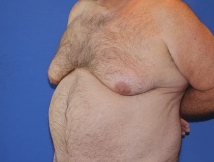 Gynecomastia Before & After Patient #2907