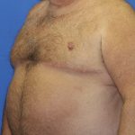 Gynecomastia Before & After Patient #2907