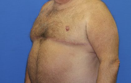 Gynecomastia Before & After Patient #2907