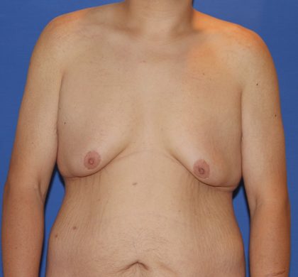 Tummy Tuck Before & After Patient #2915