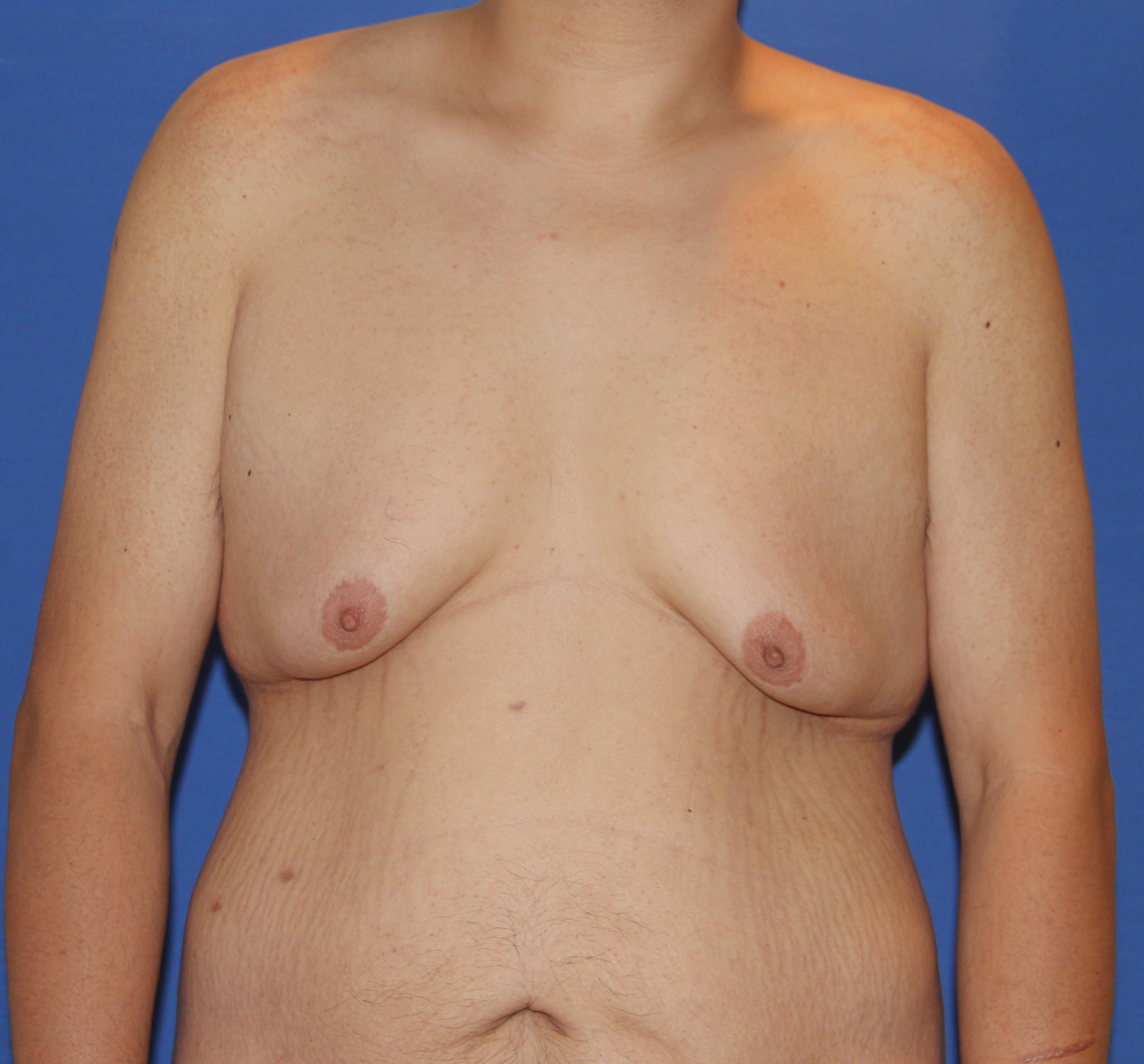 Tummy Tuck Before & After Patient #2915