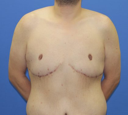 Tummy Tuck Before & After Patient #2915