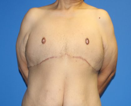 Gynecomastia Before & After Patient #2921