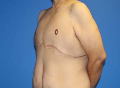 Gynecomastia Before & After Patient #2921