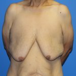 Gynecomastia Before & After Patient #2921