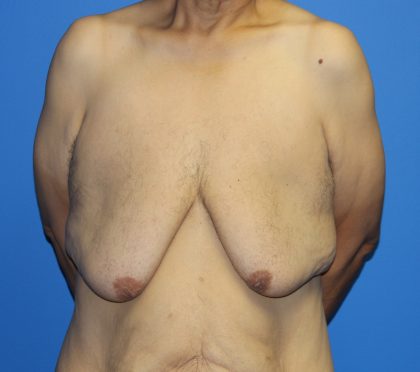 Gynecomastia Before & After Patient #2921