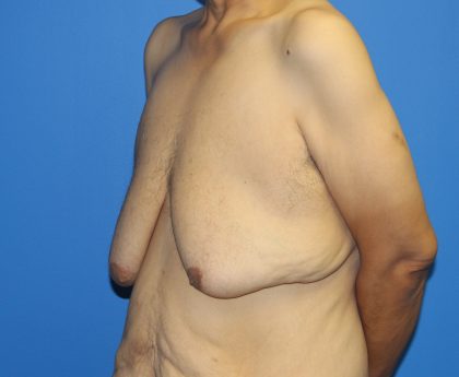 Gynecomastia Before & After Patient #2921