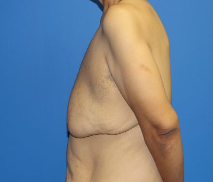 Gynecomastia Before & After Patient #2921
