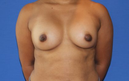 Breast Augmentation Before & After Patient #2735