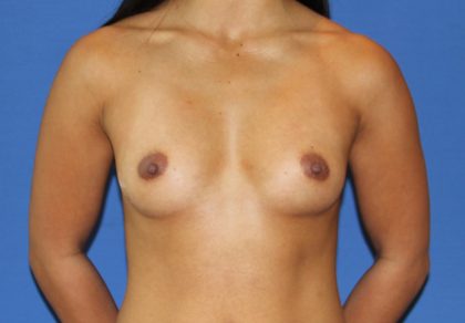 Breast Augmentation Before & After Patient #2646