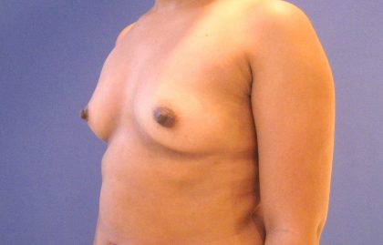 Breast Augmentation Before & After Patient #2735