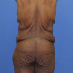 Lower Body Lift Before & After Patient #4286