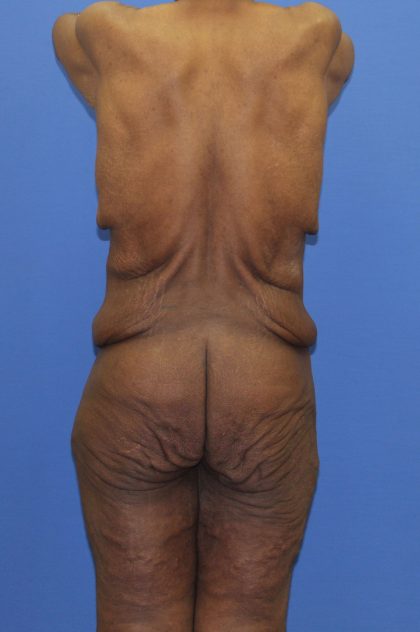 Lower Body Lift Before & After Patient #4286