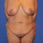 Tummy Tuck Before & After Patient #4295