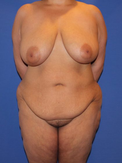 Tummy Tuck Before & After Patient #4295