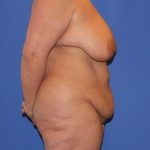 Tummy Tuck Before & After Patient #4295