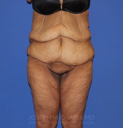 Lower Body Lift Before & After Patient #4431