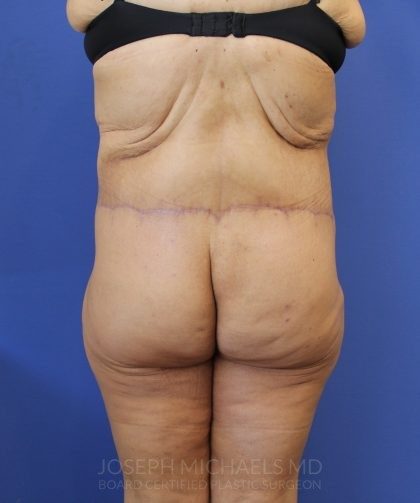 Lower Body Lift Before & After Patient #4431