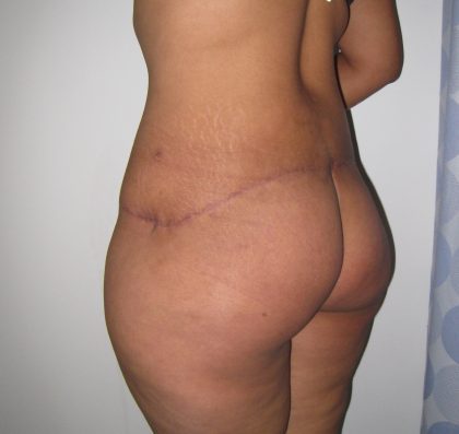 Lower Body Lift Before & After Patient #4377