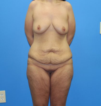 Lower Body Lift Before & After Patient #4421