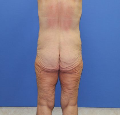 Lower Body Lift Before & After Patient #4359