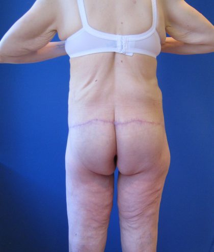 Lower Body Lift Before & After Patient #4390