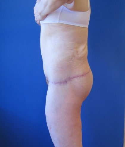 Lower Body Lift Before & After Patient #4390