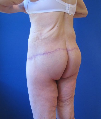 Lower Body Lift Before & After Patient #4390