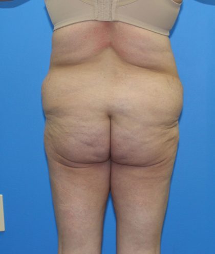 Lower Body Lift Before & After Patient #4368