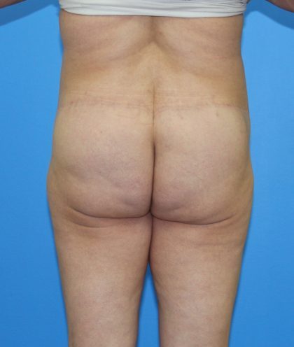 Lower Body Lift Before & After Patient #4368