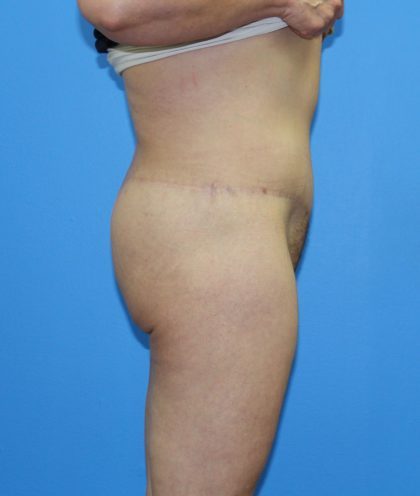 Lower Body Lift Before & After Patient #4368