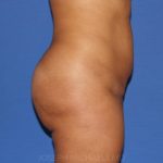 Buttock Augmentation Before & After Patient #4458