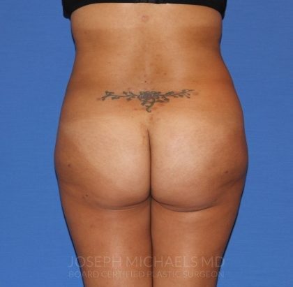 Buttock Augmentation Before & After Patient #4458