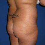 Buttock Augmentation Before & After Patient #4458